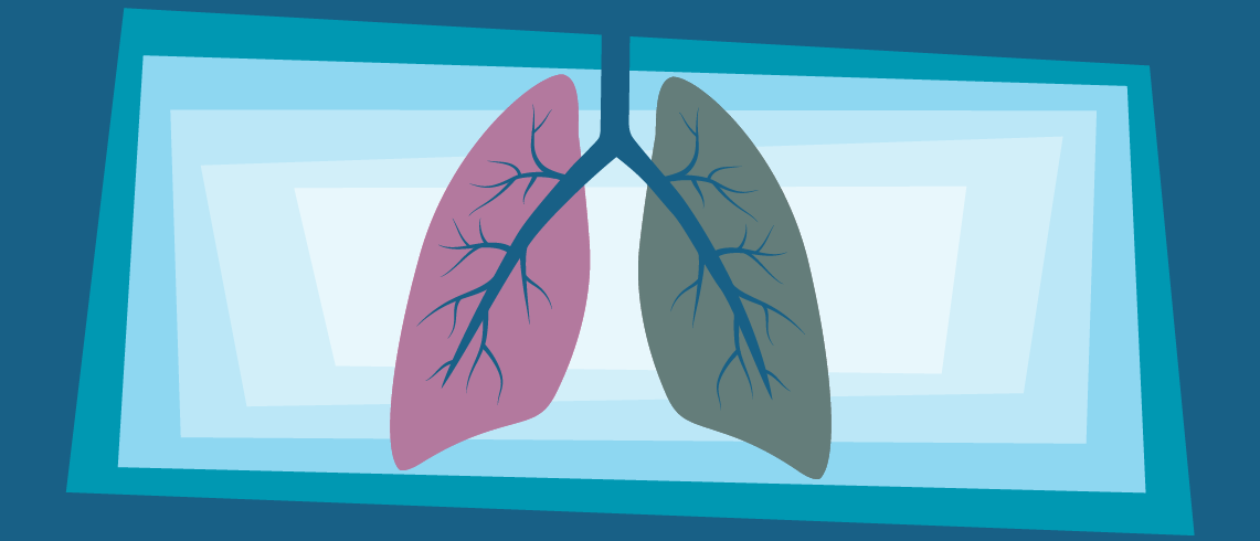 Who Should Have Lung Cancer Screening?